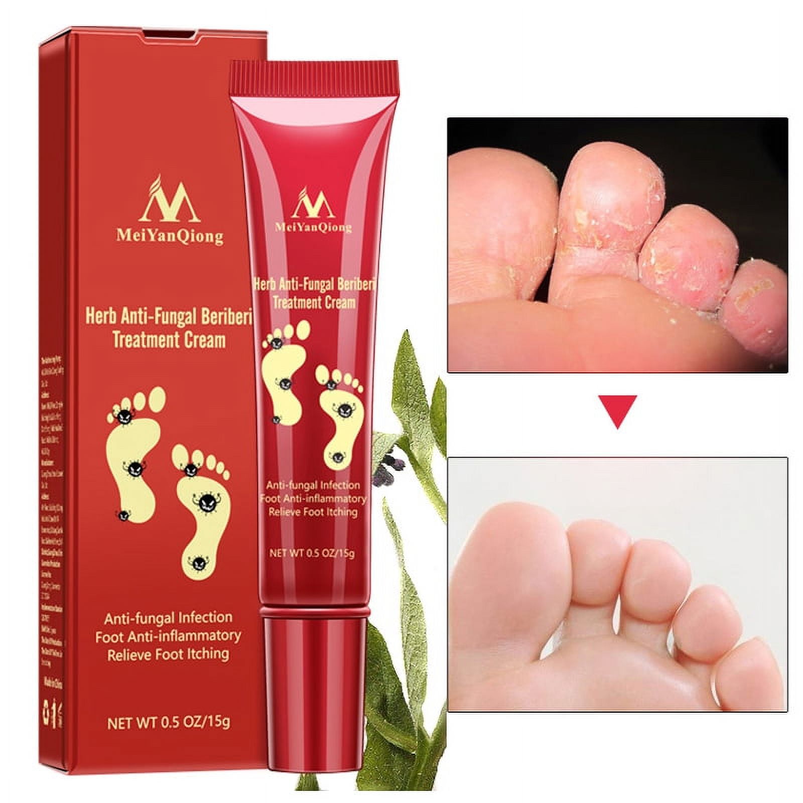 Nail Fungal Treatment Ointment | Nail Fungus Removal Cream | Fungus  Treatment Feet - Foot Care Tools - Aliexpress